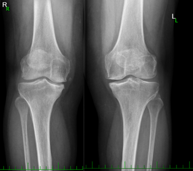 Osteoartróza, gonartroza 3. stupně